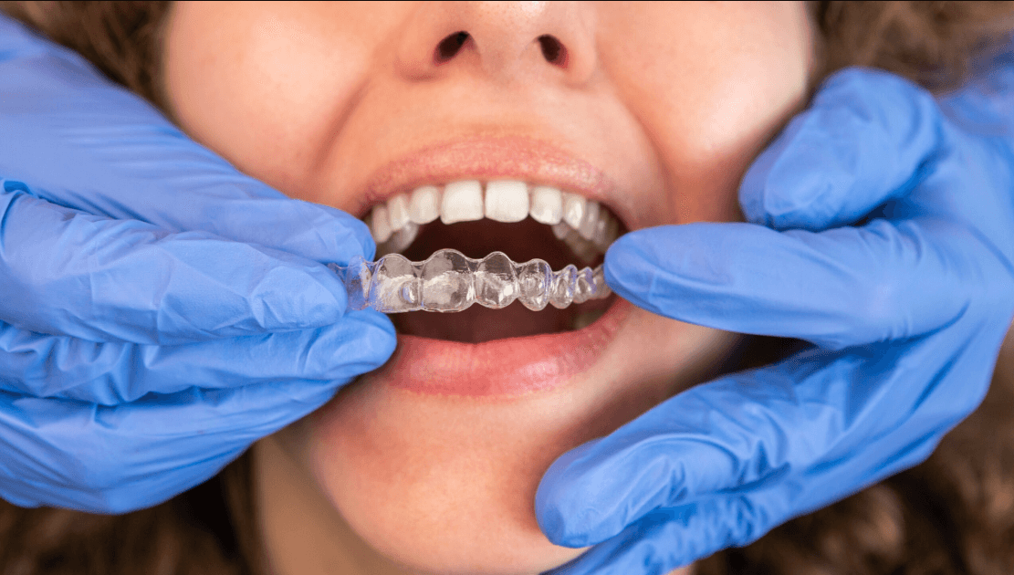 Invisalign and the Art of Minimising Dental Treatment Timelines