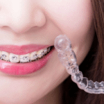 Why More Adults in Colorado Are Choosing Invisalign Over Traditional Braces
